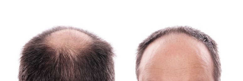 how to regrow hair on bald spot